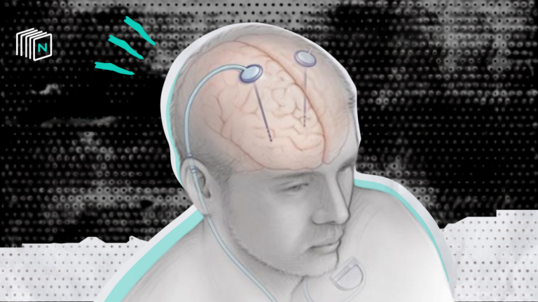 Deep Brain Stimulation Shows Promise in Mapping Dysfunctional Brain Circuits