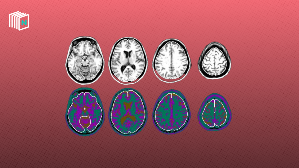 Sinaptica's neuromodulation therapy slows Alzheimer's brain atrophy
